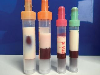 A man in Germany had extraordinarily high levels of triglycerides, a type of fat, in his blood. Above, samples of the man's blood about two hours after they were drawn. The white is the fat.