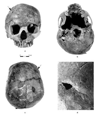 skull of child with brain damage