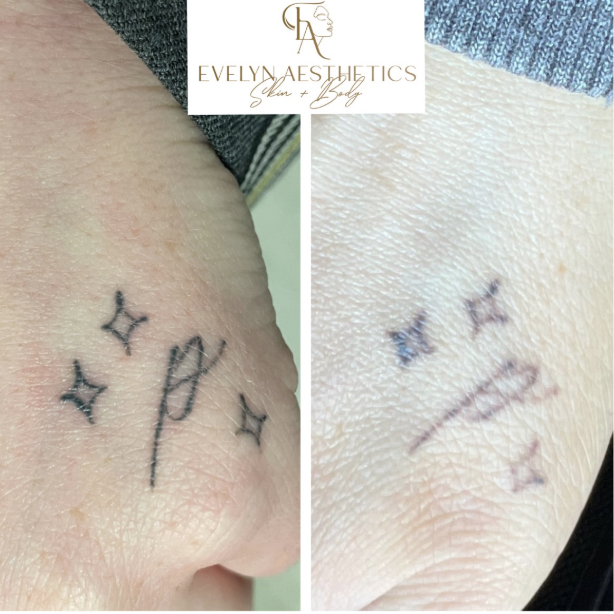 before and after pico laser on a tattoo