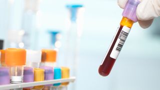Laboratory technician preparing blood sample for medical testing in laboratory.