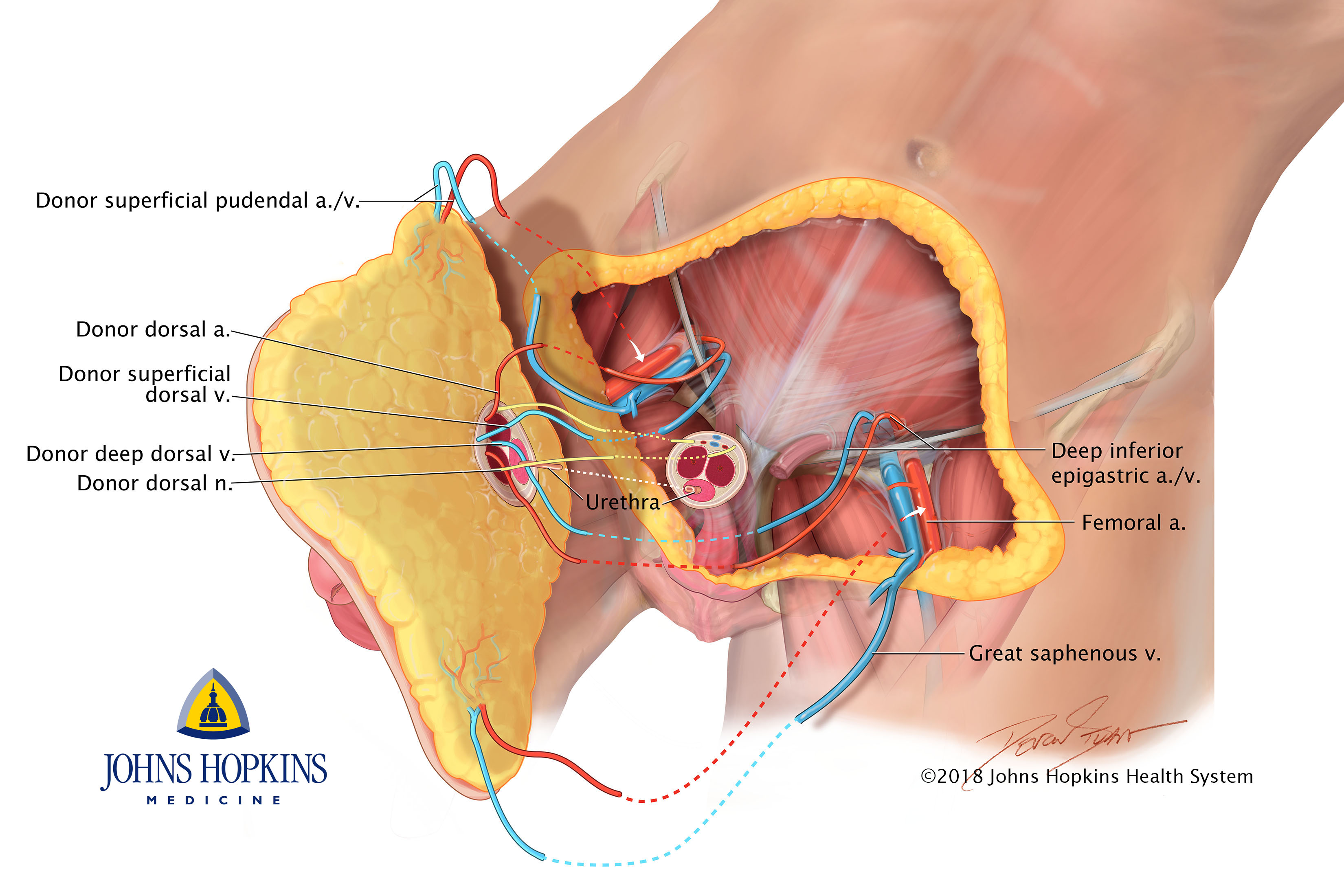 Surgeons at Johns Hopkins Medicine performed the first full penis transplant.
