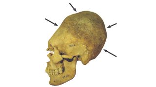 Artificially deformed skull of an adult woman. Permanent binding during childhood caused the elongation of the braincase and depressions in the bone.