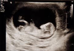 Baby scan, fetus, pregnancy scan, ultrasound scan 