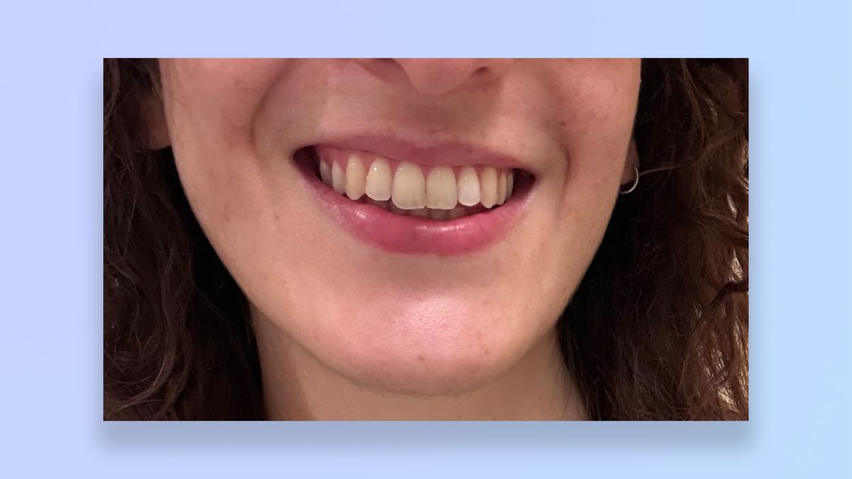 a photo of the author's teeth before/after using the suri core 1.0 toothbrush