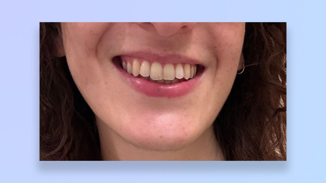a photo of the author's teeth before/after using the suri core 1.0 toothbrush