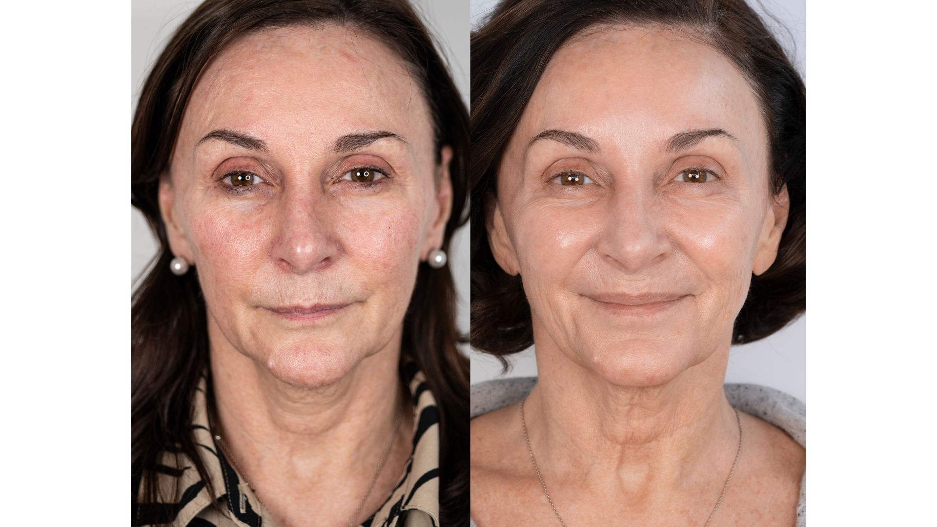 Shirley Ballas pictured before and after having Neogen Plasma treatments
