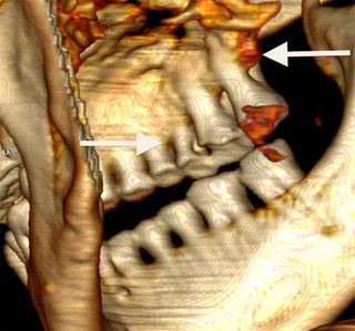 CT Scan of Otzi the Iceman&#039;s teeth