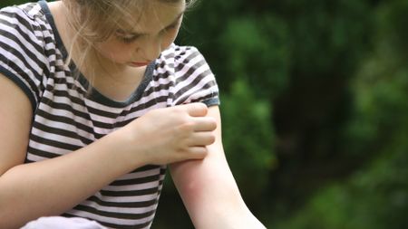 A young girl looks down at a swollen, red mosquito bite on her arm