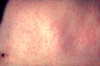 Measles rash