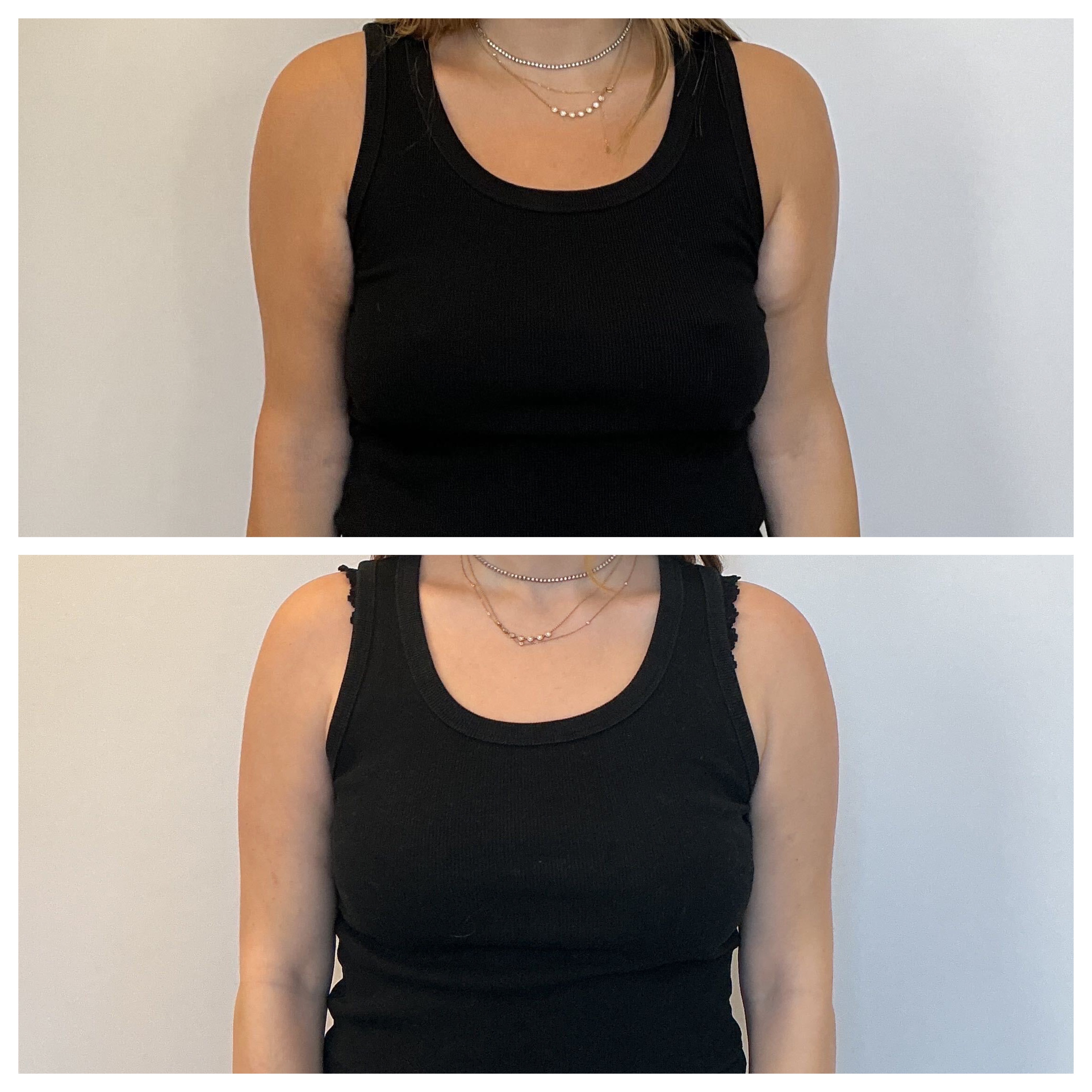 samantha holender before and after surgery