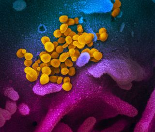 This scanning electron microscope image shows the new coronavirus (yellow) among human cells (blue, pink and purple).