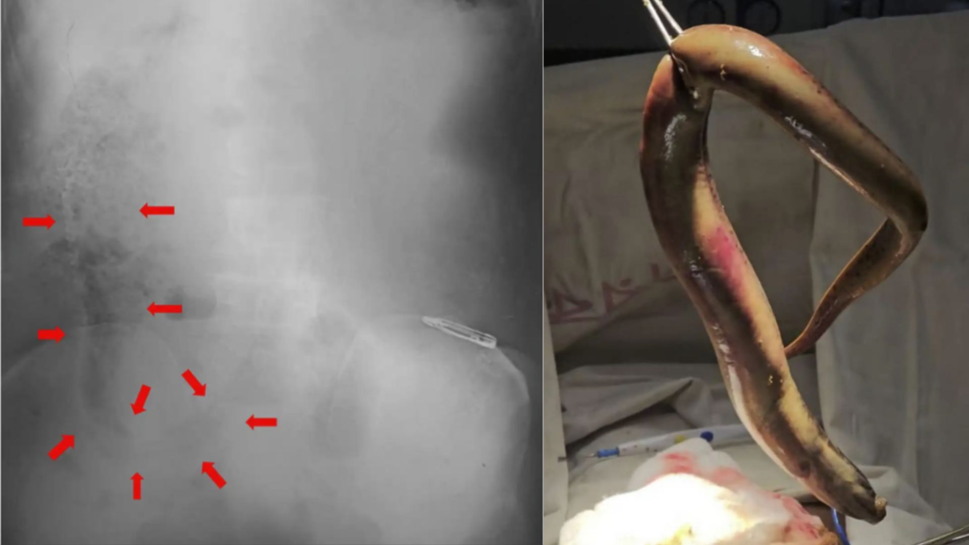 Two images side by side, the left showing an X-ray of a human torso and the right showing a large brown eel being held by metal tongs