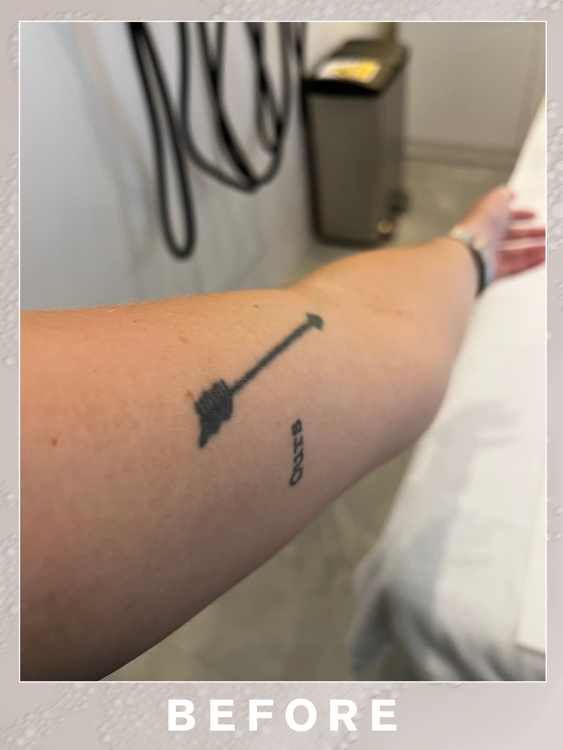 A before picture of the tattoo that one Who What Wear UK editor is getting removed