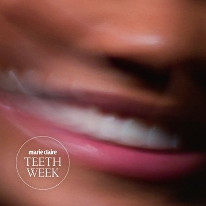 Veneers