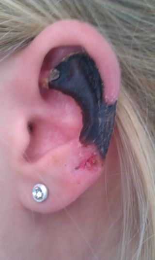 The ear of a woman bitten by a Mediterranean recluse. The black tissue is dead, or necrotic. 