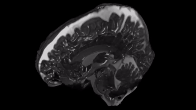 See how the brain wobbles with each heartbeat in incredible new videos