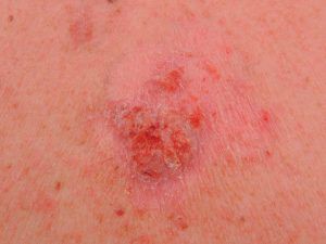 cancerous moles: Basal cell carcinoma