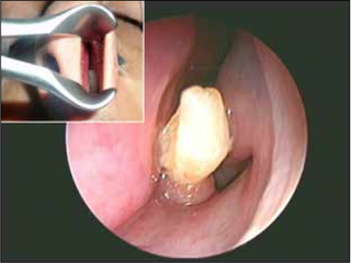 A tooth seen inside a man's nose.