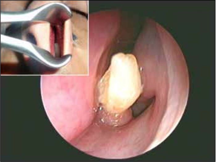 A tooth seen inside a man&#039;s nose.