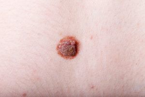 What causes skin tags? And how to tell the difference between a skin tag and a mole