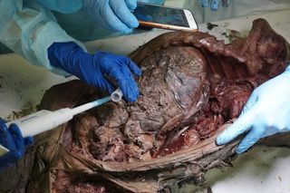 Researchers collect liquid blood from the ice age foal found frozen in Siberian permafrost.