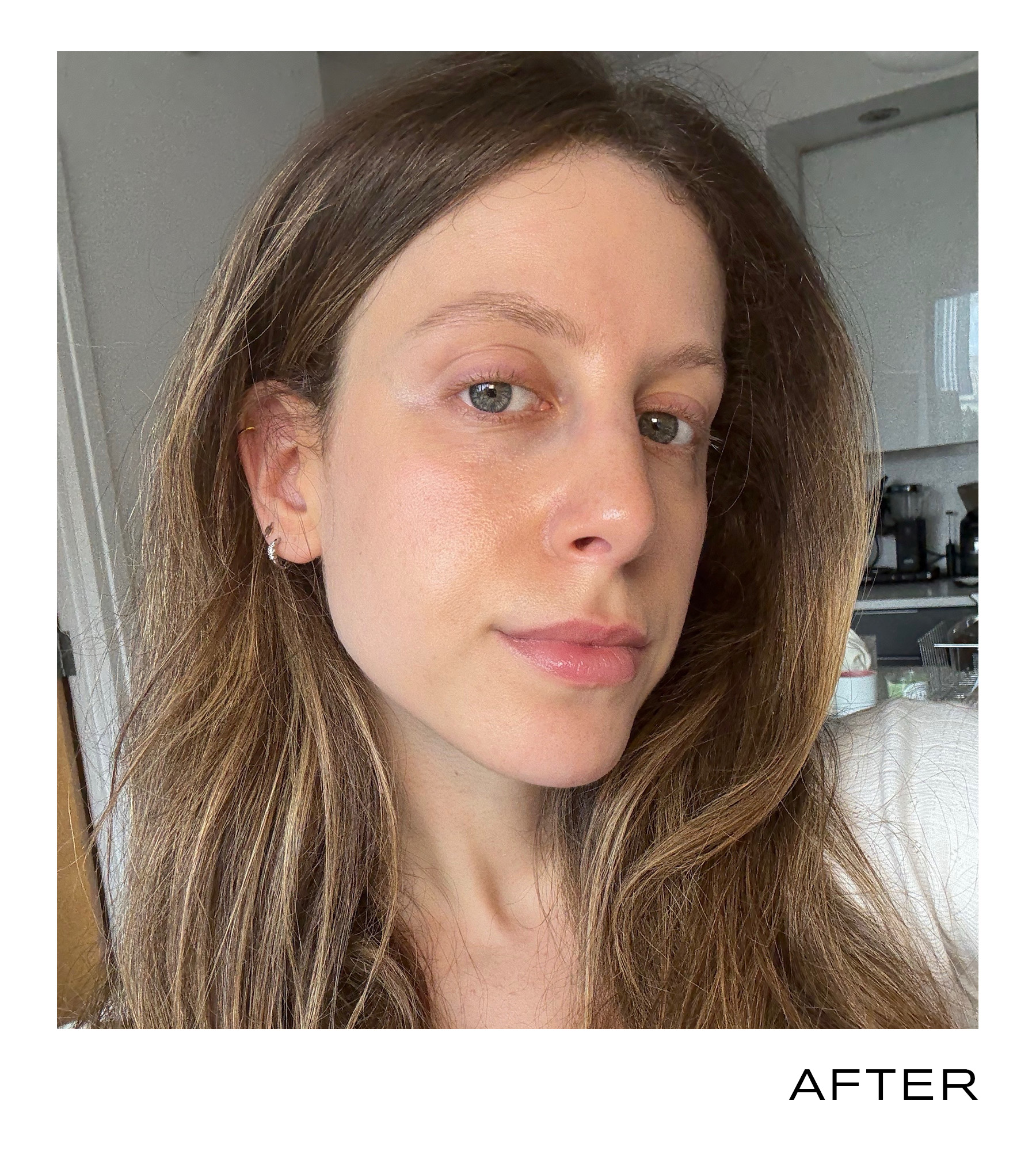 Photo of Jamie Schneider after 2 weeks of ice water facials