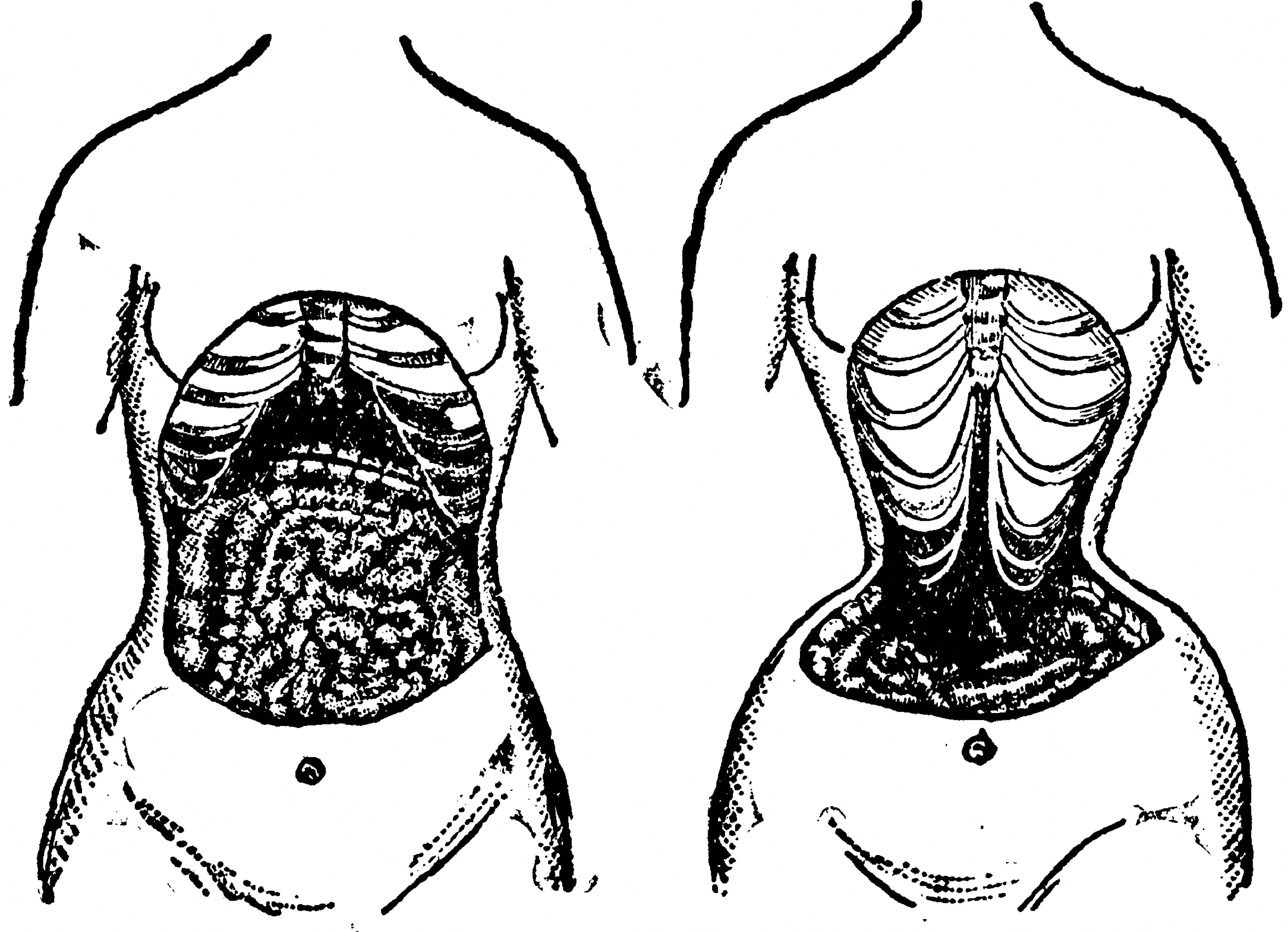 Two pictures of a woman's torso; one showing a woman without a corset, the other showing the effects on the internal organs and bones when wearing a corset.