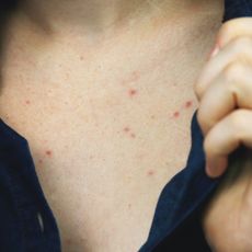 close up of woman with chest acne