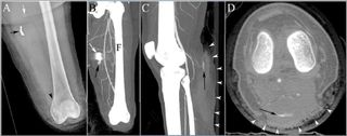 This image shows the injuries to the legs of a bombing victim whose bones were separated at the knee joint in the left. The patient had to undergo an urgent amputation at the knee level. Panel A shows the victim’s leg after amputation, black arrow points to the shrapnel and black arrowhead shows a fracture. The white arrow in the image shows a surgical stable. Panel B shows an image of bleeding from an artery near the shrapnel. Panel C and D show another vascular injury in the right leg pointed by the black arrow. White arrowheads point to extensive injury to calf muscles.