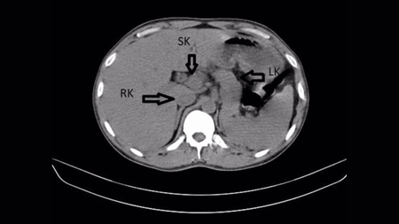 An X-ray image showing a cross section of a human back, with a white circle of the vertebrae towards the bottom surrounded by gray tissue. Three arrows point to the left, right, and down next to three circles in the gray area. 