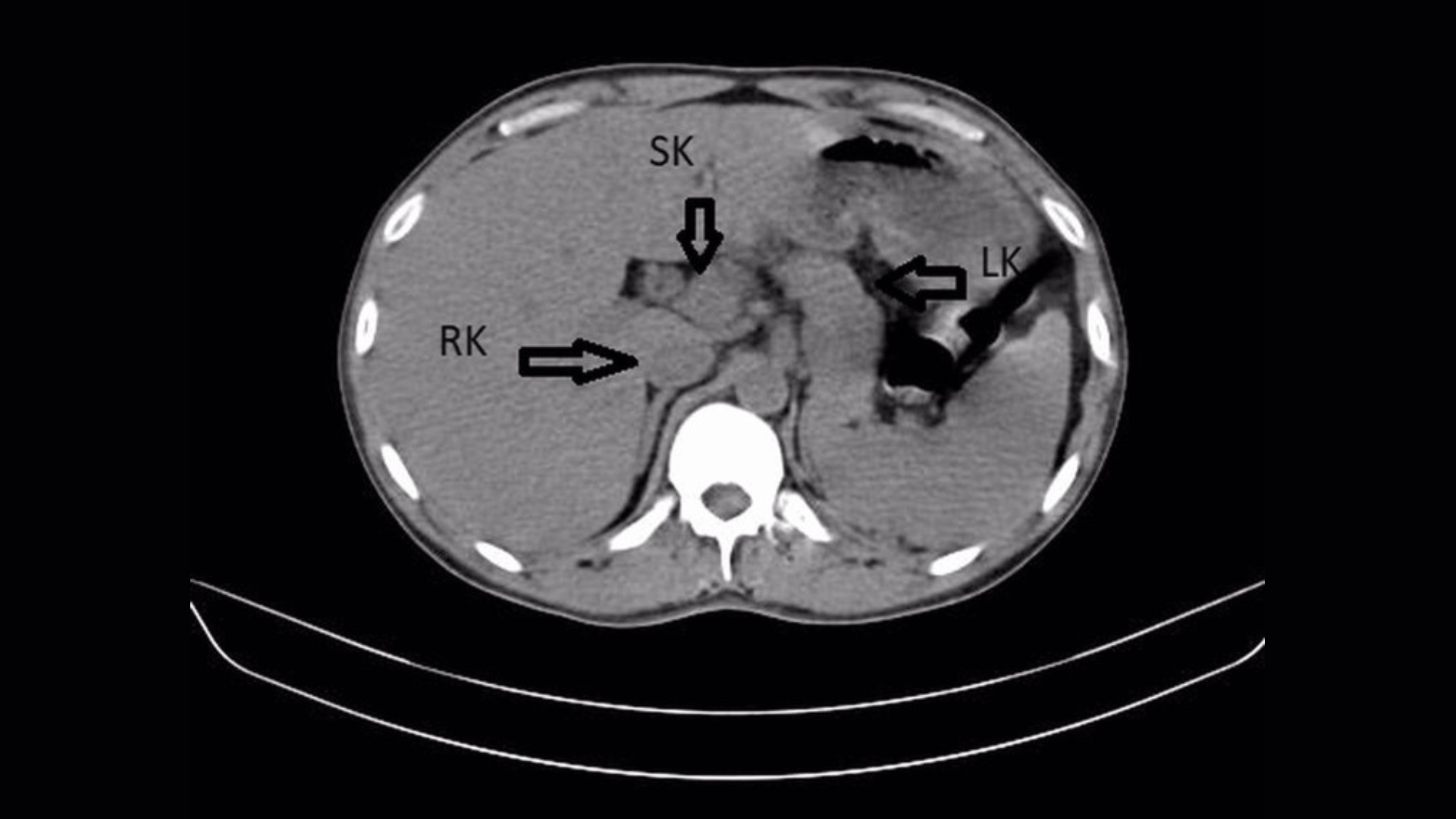A CT scan showing the man's abdomen from above, with his three kidneys labeled with arrows