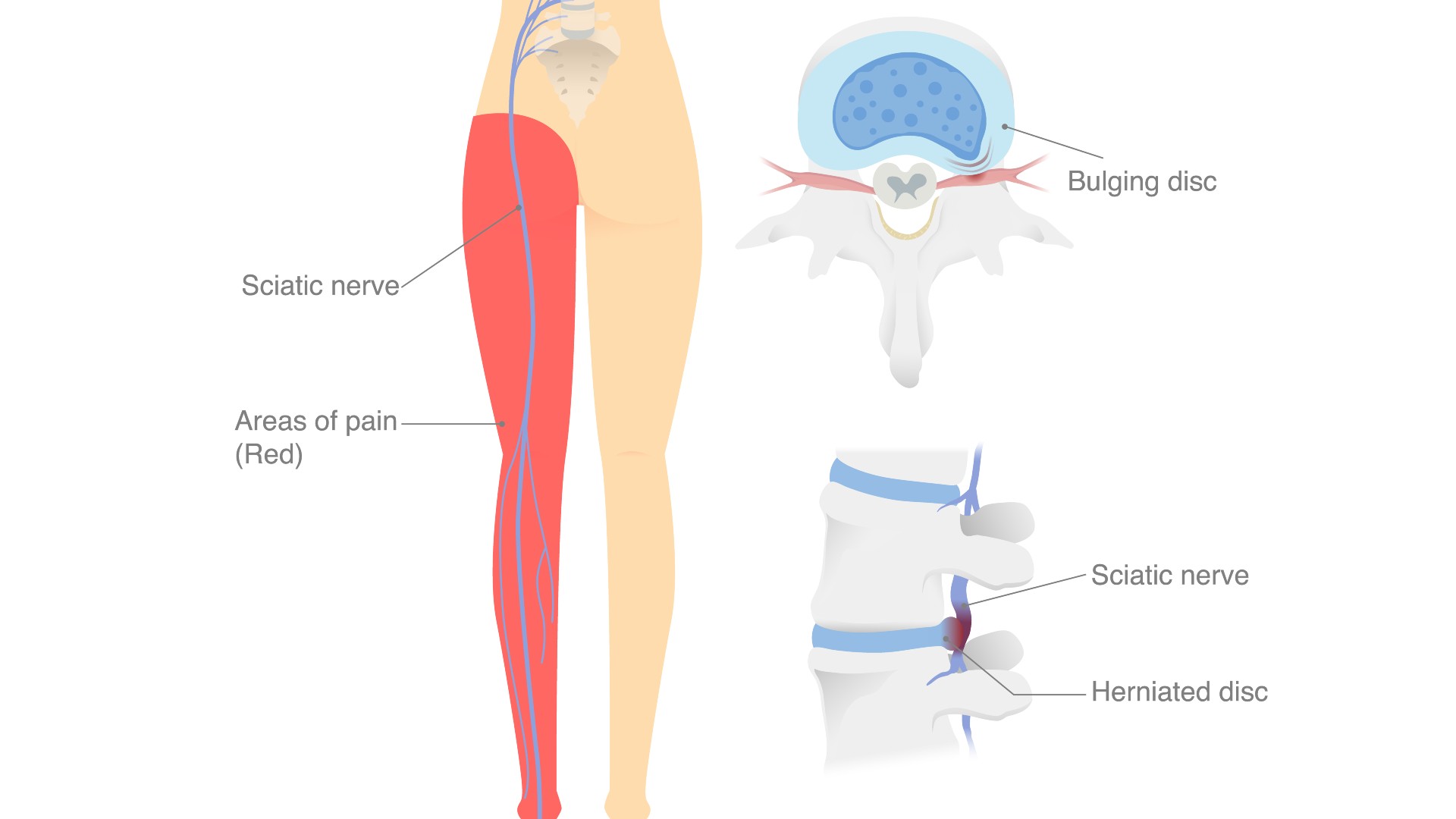 Image of sciatic nerve on the human body