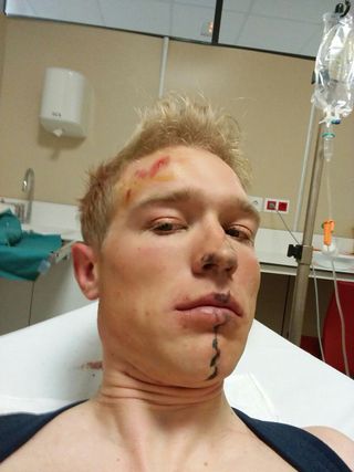 Magnus Cort Nielsen broke his collarbone in a training ride crash