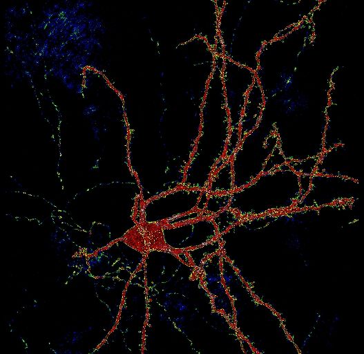 Medium spiny neuron