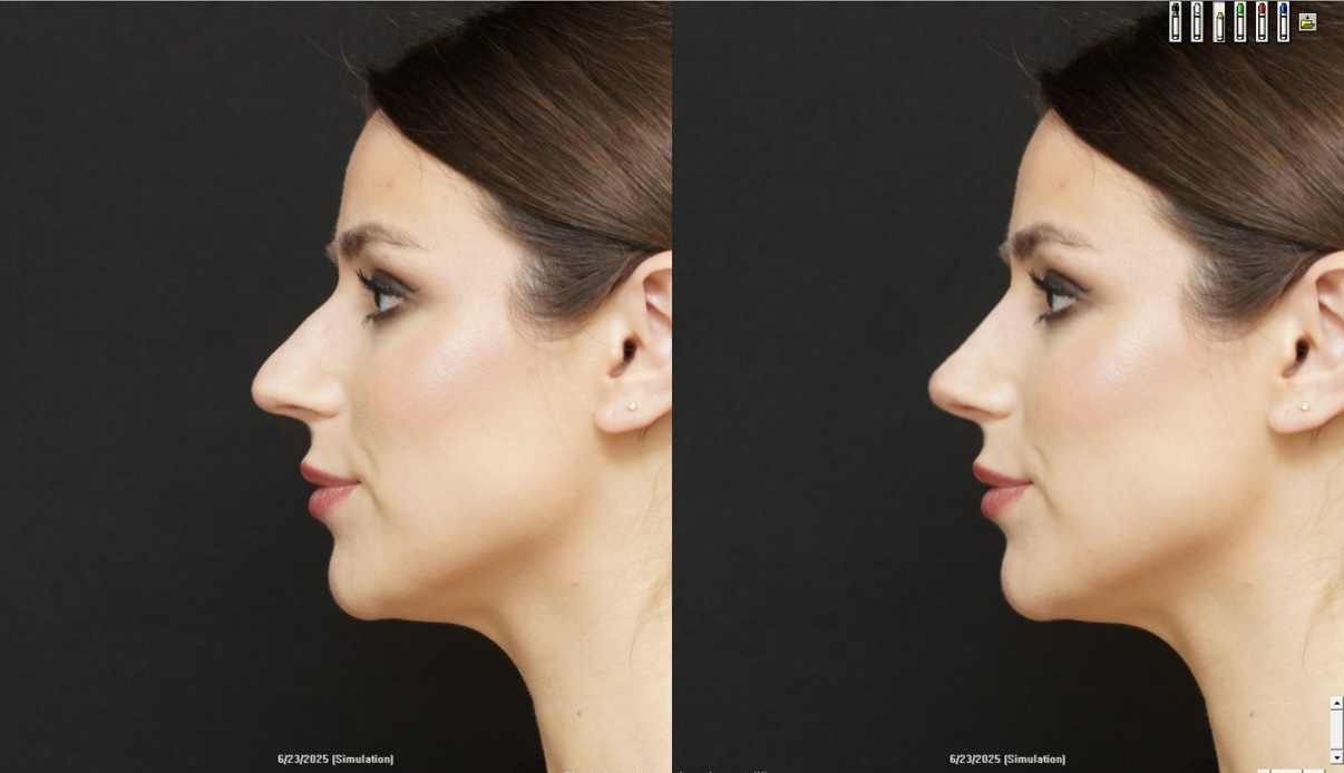 a simulated nose before and after rhinoplasty surgery with two photos of a white woman side by side