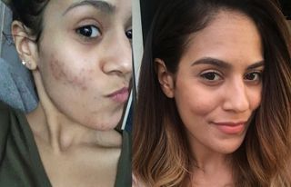 Lamya's skin changes during her acne journey