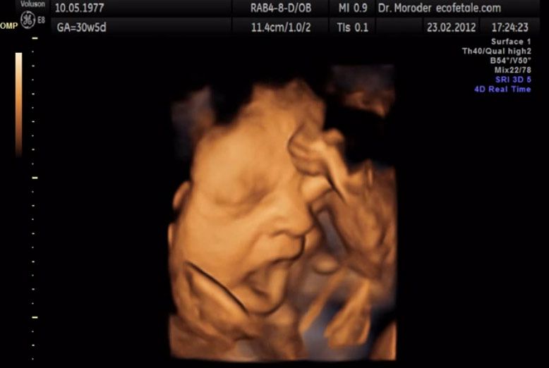 Image Gallery: Yawning in the Womb | Live Science