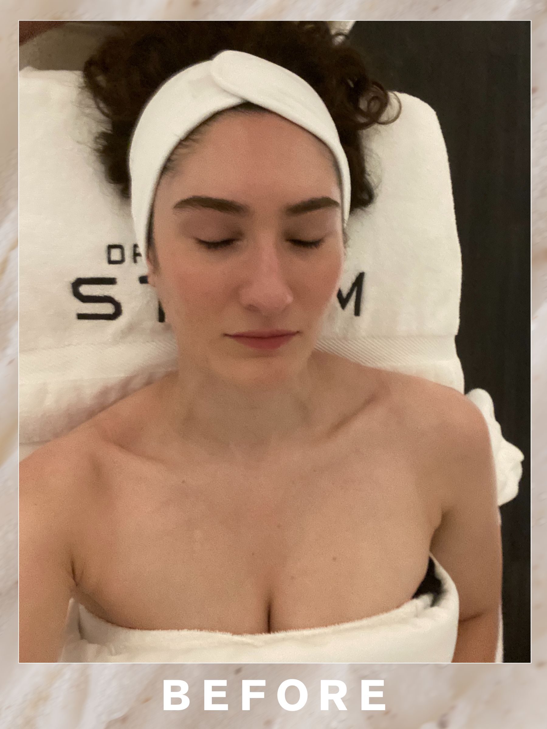 Natalie before her Dr Barbara Sturm Adult Acne Facial