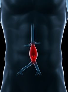 A diagram of an aneurysm within a man's body