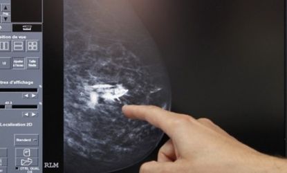 A doctor points to a breast cancer tumor on an X-ray: After two years, 65 percent of the breast-cancer patients who received a new drug treatment called T-DM1 were still alive versus 47 of a 