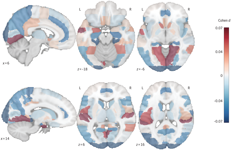 A scan of the brain