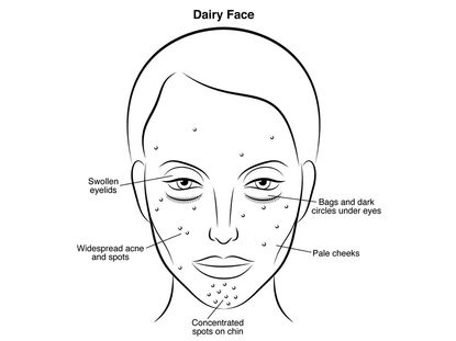 Sugar Face: What Eating A Heavy Sugar Diet Is Doing To Your Skin ...