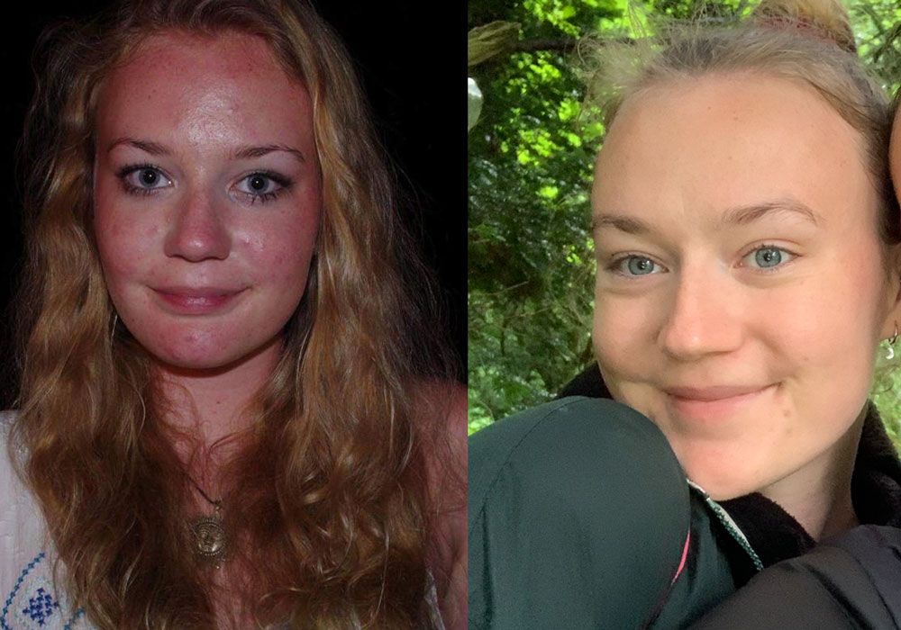 A Fashion's Digest reader who shares her experience on roaccutane