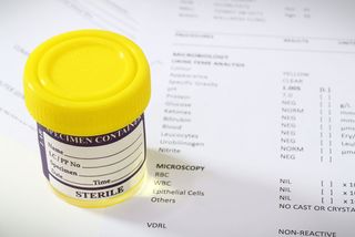An image of a urine sample over a medical report.