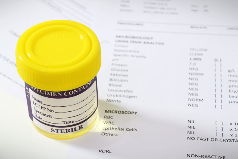 An image of a urine sample over a medical report.