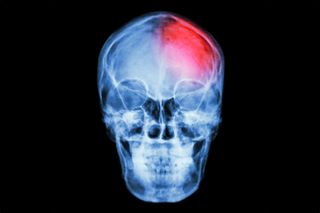 Brain injury image