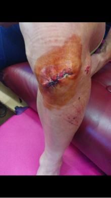 Damiano Cunego received four stitches following his crash at the Tour of Poland.