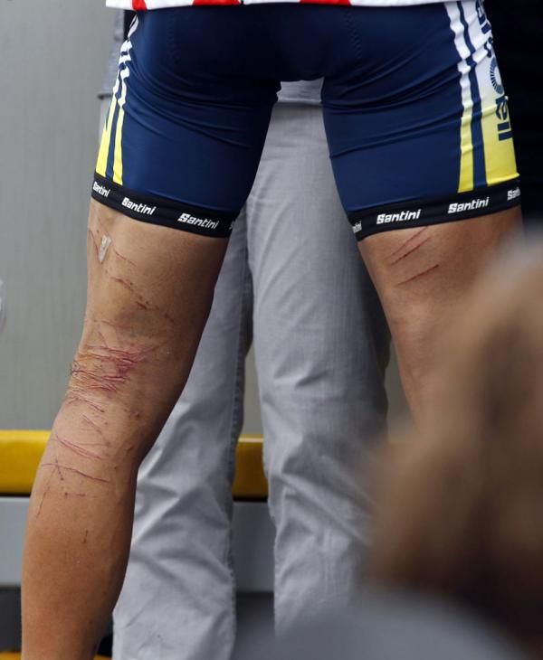 Johnny Hoogerland's legs are still covered in scars
