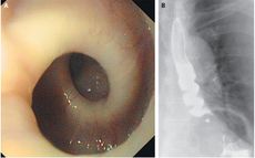  woman had an esophagus that twisted itself into a corkscrew shape whenever she swallowed. Above, images of the esophagus