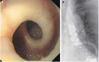  woman had an esophagus that twisted itself into a corkscrew shape whenever she swallowed. Above, images of the esophagus